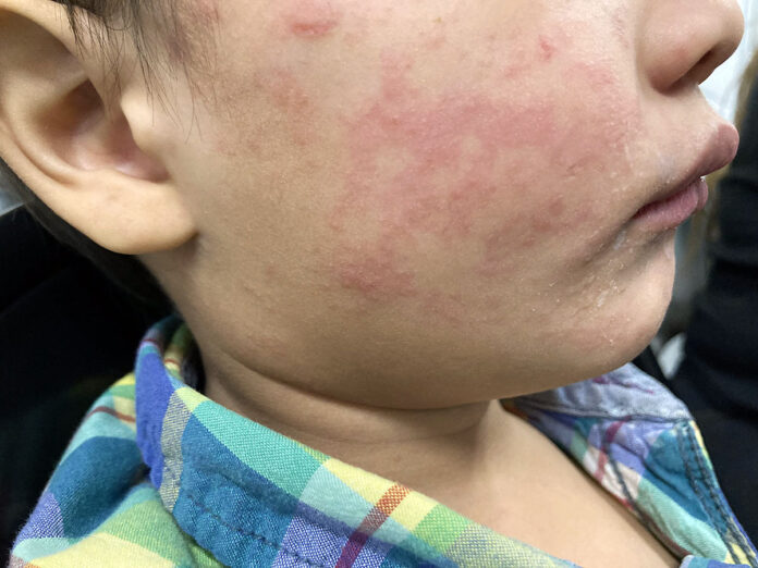 Measles
